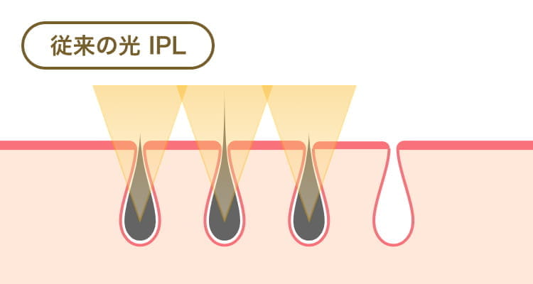 従来の光 IPL